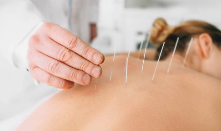 50% 2024 Package 10 - Acupuncture